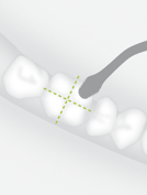 W&H B7 — Пилка для забора костных блоков, расщепления альвеолярного гребня, разделения корней зуба