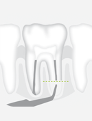 W&H R2LD — Тонкая насадка с алмазным покрытием для ретроградной обработки корневого канала