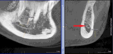 Рисунок 4. КЛКТ Сагиттальныи и коронарныи реформаты переднего отдела нижнеи челюсти..jpg