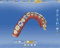 CEREC AC OMNICAM ПРОСТОЕ СКАНИРОВАНИЕ БЕЗ АНТИБЛИКОВОГО СПРЕЯ 16.jpg
