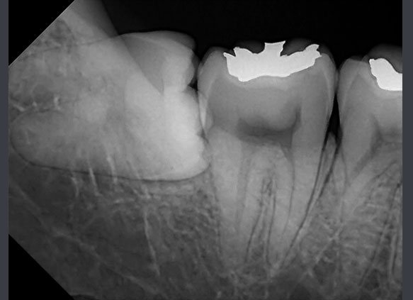 RIOSensor RIS500 - цифровой радиовизиограф 3.jpg