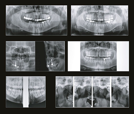 GENORAY Papaya 3D 16x14 - компьютерный томограф