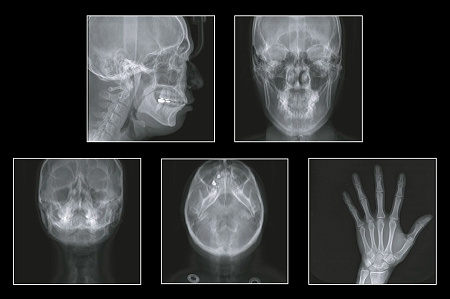 GENORAY Papaya 3D 23x24 - компьютерный томограф с цефалостатом One Shot