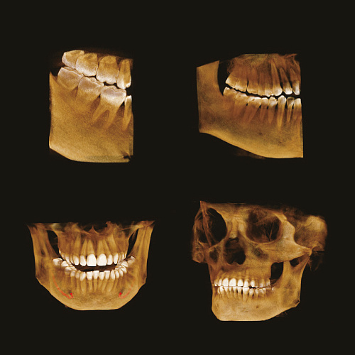 GENORAY Papaya 3D 16x14 - компьютерный томограф